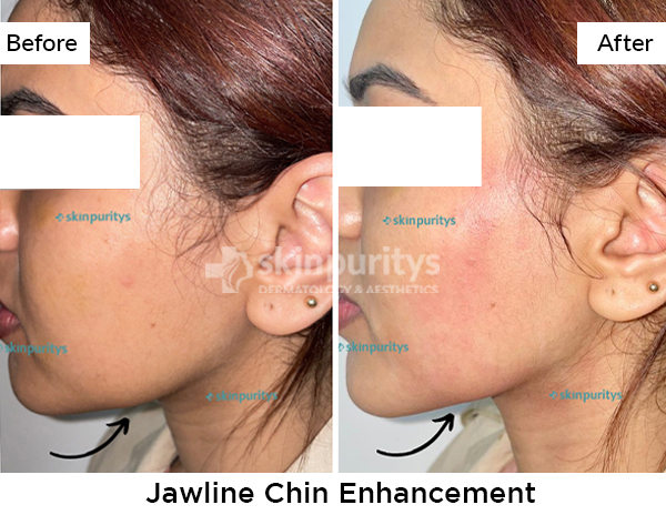 Non Surgical Facial Enhancements results